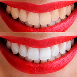 Photobleaching teeth