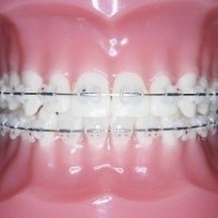 керамические и сапфировые брекеты